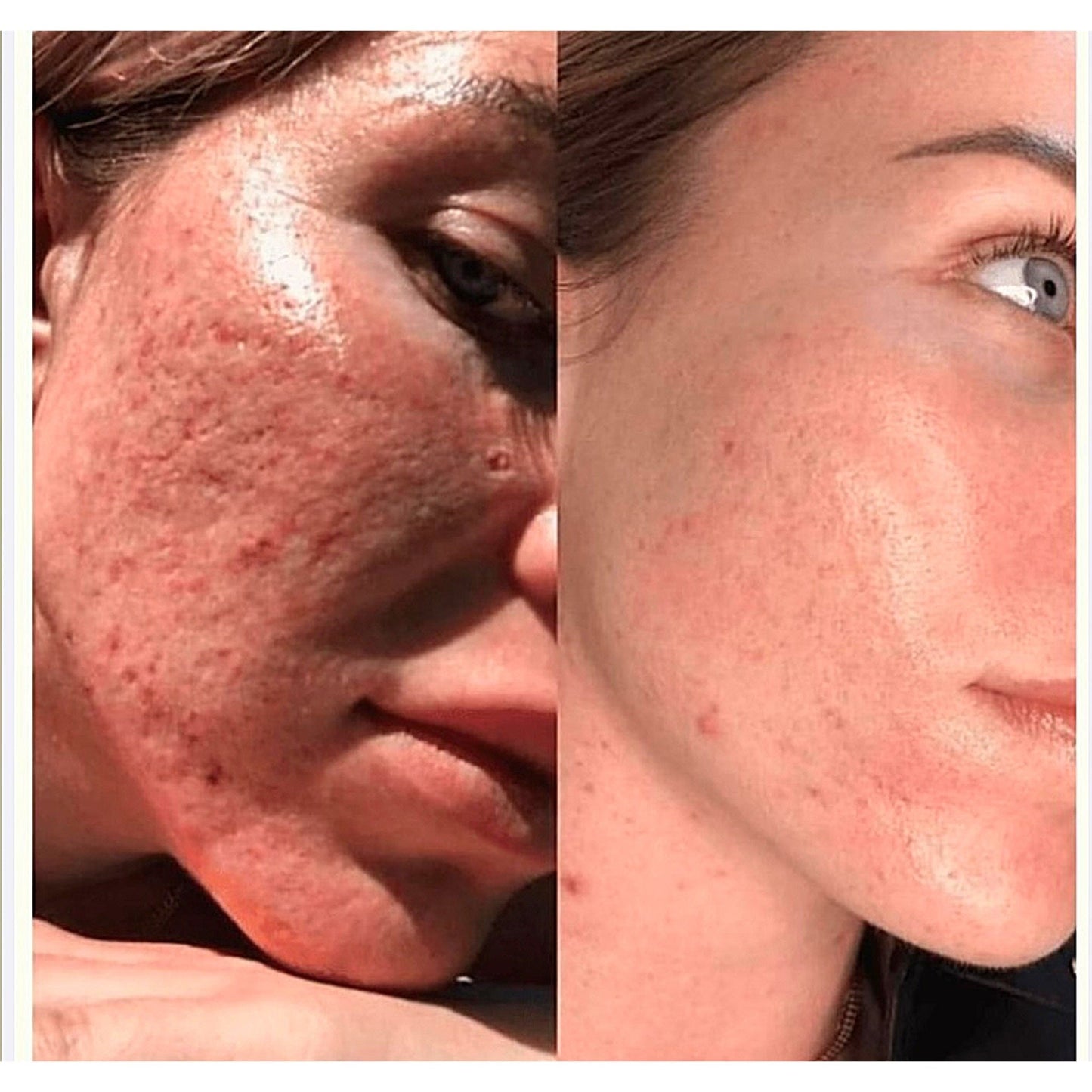 Micro RF Needle - Kardelen - beauty